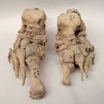 New study suggests leprosy came from Europe