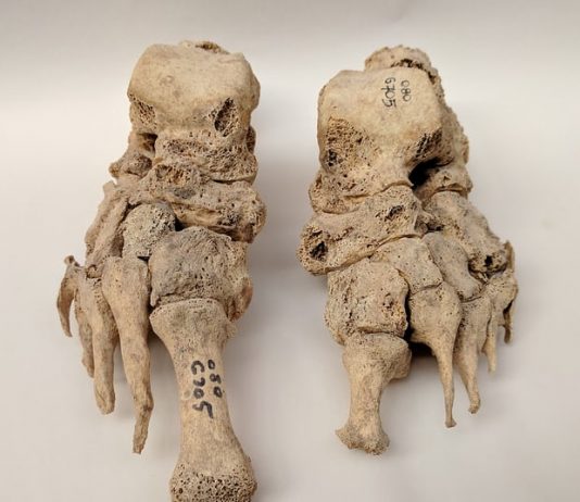 New study suggests leprosy came from Europe