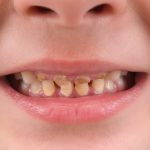 Rotten teeth health warning on sugary drinks could deter buyers