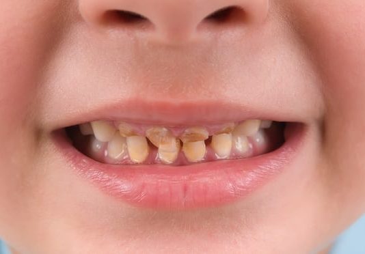 Rotten teeth health warning on sugary drinks could deter buyers