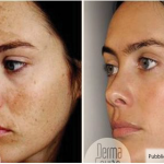 Skin hyperpigmentation, causes and remedies
